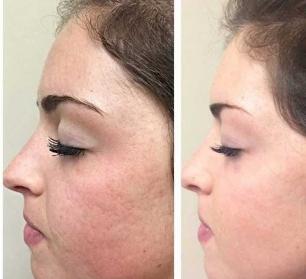 ديرما بن derma pen